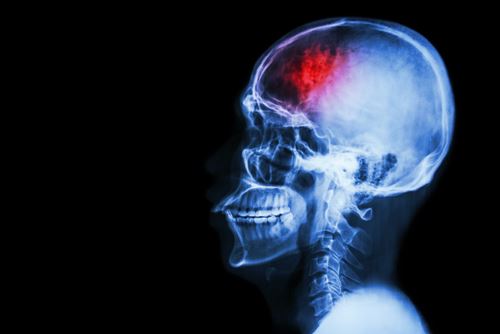 x-ray showing brain injury